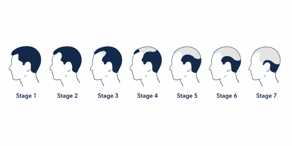 seven stages of male pattern hair loss shown as a Norwood scale diagram.